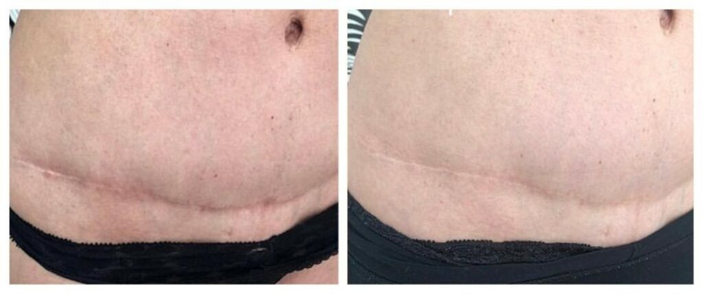 Cicatriz abdominoplastia