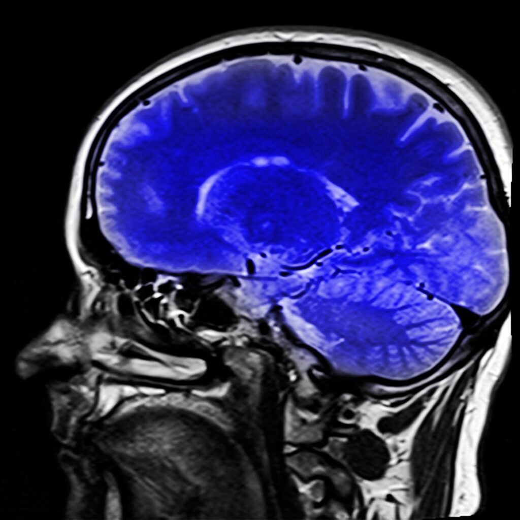 SLYM, estructura cerebral hallada recientemente