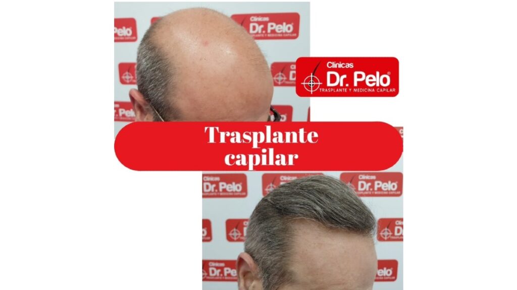 Injerto capilar en Sevilla